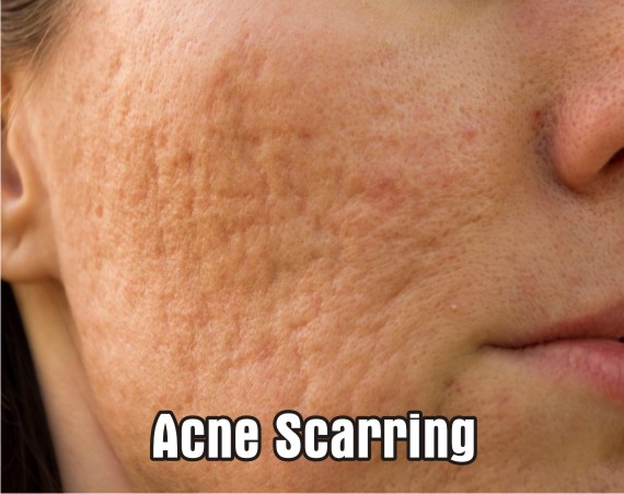 Treatments for Acne and Acne Scarring